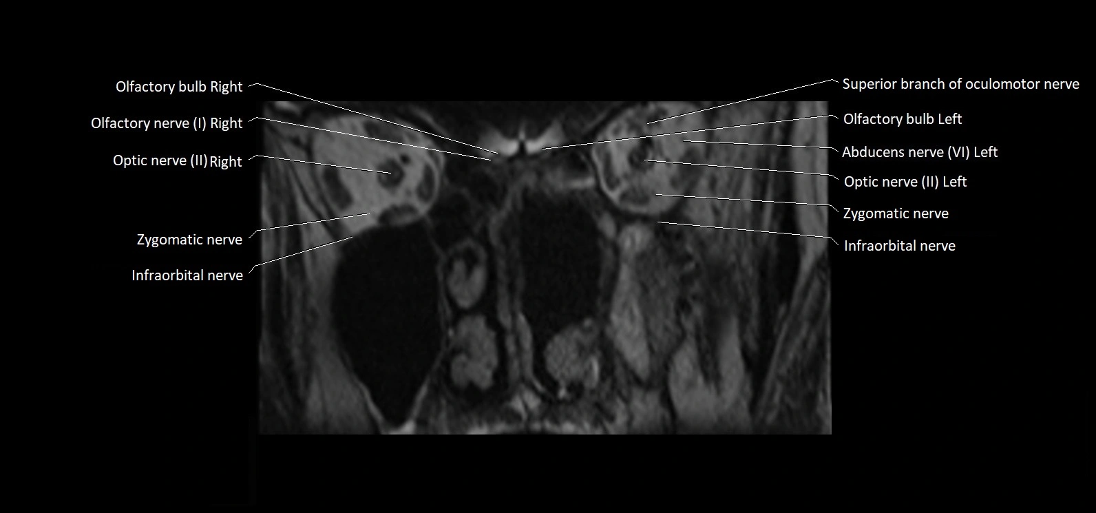 Cranial nerve cross sectional anatomy coronal 3T MRI image 7.webp